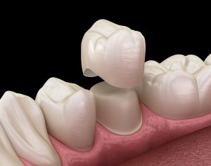 Dental crown premolar tooth assembly process. Medically accurate 3D illustration of human teeth treatment in Greensburg, PA